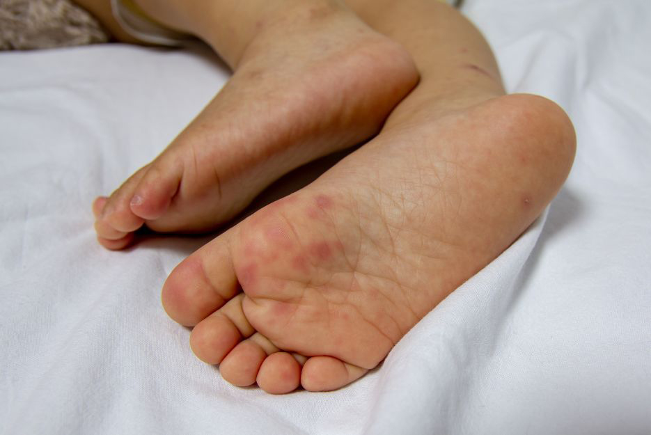 Feet With Disease